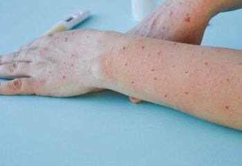 Nueva York acumula mil casos de viruela del mono