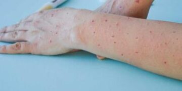 Nueva York acumula mil casos de viruela del mono