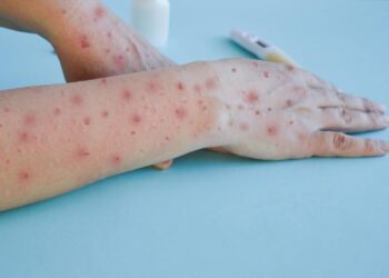 Honduras registra el tercer caso de contagio con la viruela del mono