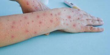 Honduras registra el tercer caso de contagio con la viruela del mono