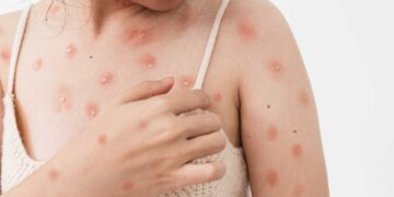 Muere en Perú un paciente con la viruela del mono