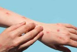 Perú supera los 300 casos de la viruela del mono