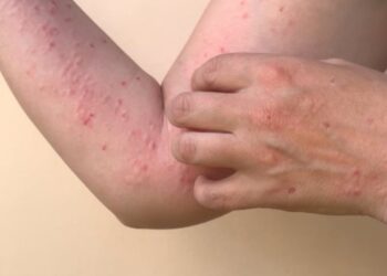 México detecta 118 nuevos casos de viruela del mono para un total de 504