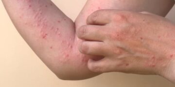 México detecta 118 nuevos casos de viruela del mono para un total de 504