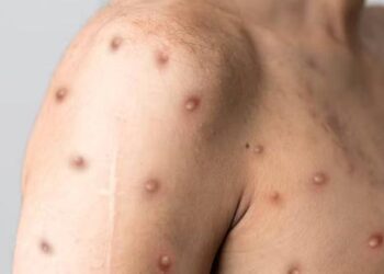 Salud Pública notifica tres nuevos casos de viruela del mono