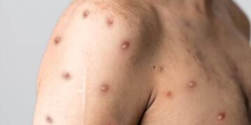 Salud Pública notifica tres nuevos casos de viruela del mono