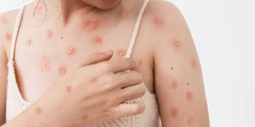 Reportan tres nuevos casos de viruela del mono