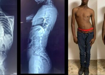 Hospital Ney Arias Lora devuelve vida a pacientes con desviación severa de columna