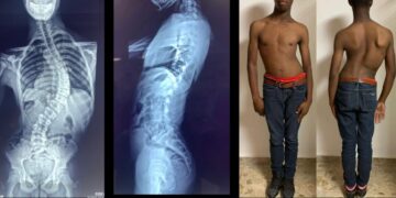 Hospital Ney Arias Lora devuelve vida a pacientes con desviación severa de columna