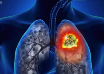 17 de noviembre Día Internacional de la Lucha Contra el Cáncer de Pulmón