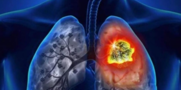 17 de noviembre Día Internacional de la Lucha Contra el Cáncer de Pulmón