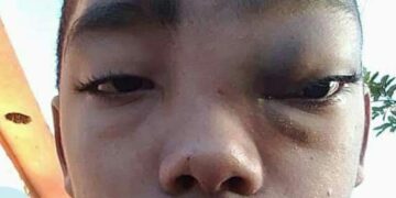 Solicitan ayuda económica para operar adolescente con tumor en la cara