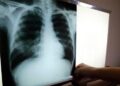El SRSM identificó 1,896 casos tuberculosis en 2022; resalta tratamiento a domicilio