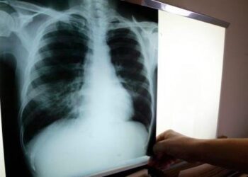 El SRSM identificó 1,896 casos tuberculosis en 2022; resalta tratamiento a domicilio