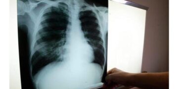 El SRSM identificó 1,896 casos tuberculosis en 2022; resalta tratamiento a domicilio