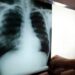 El SRSM identificó 1,896 casos tuberculosis en 2022; resalta tratamiento a domicilio