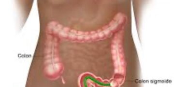 Instituto Dominicano de Gastroenterología realizará seminario sobre prevención de cáncer de colon