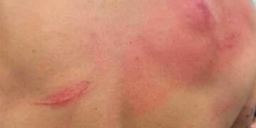 Bad Bunny muestra su espalda con arañazos y hematomas tras pelea en la WWE