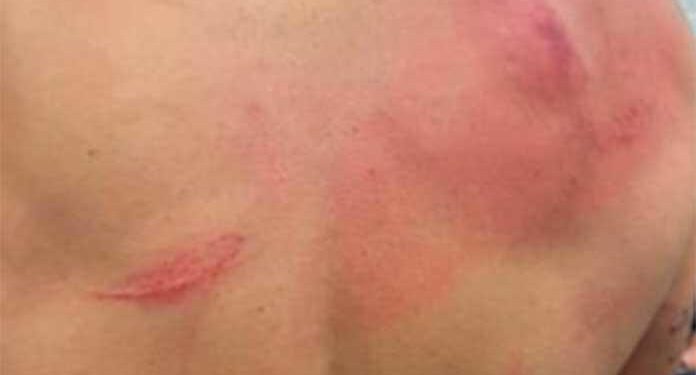 Bad Bunny muestra su espalda con arañazos y hematomas tras pelea en la WWE