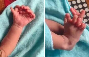 Bebé nace con 26 dedos en India y padres creen que es reencarnación de una Deidad