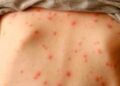 La OMS alerta de la “alarmante” subida de casos de sarampión en Europa