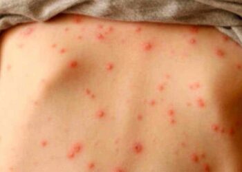 La OMS alerta de la “alarmante” subida de casos de sarampión en Europa