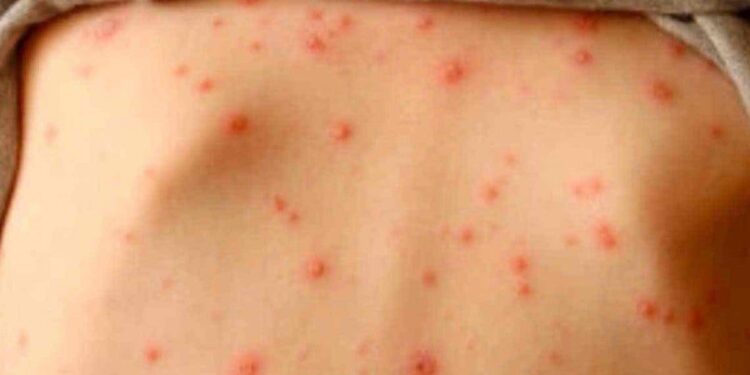 La OMS alerta de la “alarmante” subida de casos de sarampión en Europa