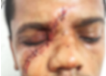 Joven le propina machetazo a hermano en la cara y emprende la huida en Azua