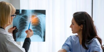 Últimos avances en los tratamientos que buscan frenar el cáncer de pulmón