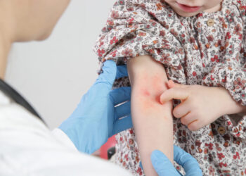 El vapeo en lugares cerrados provoca la aparición de dermatitis atópica en los niños
