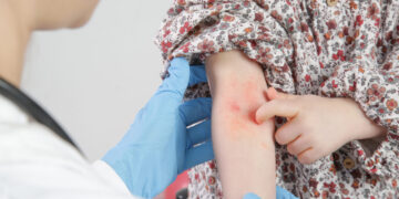 El vapeo en lugares cerrados provoca la aparición de dermatitis atópica en los niños