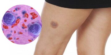 Nuevo tratamiento para la leucemia mieloide aguda que está disponible en Argentina