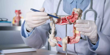 Nueva estrategia logra reducir las cirugías por cáncer de recto