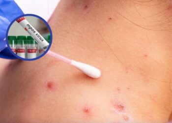 OMS incorpora vacuna contra viruela del mono a lista de productos que considera seguros y eficaces