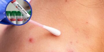 OMS incorpora vacuna contra viruela del mono a lista de productos que considera seguros y eficaces