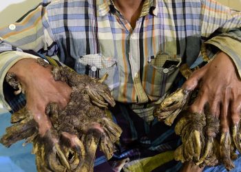 El extraño síndrome del hombre árbol: qué es y cómo afecta a quienes lo padecen