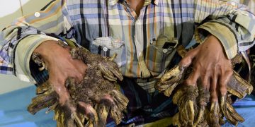 El extraño síndrome del hombre árbol: qué es y cómo afecta a quienes lo padecen