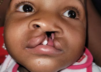 Inician amplia Jornada de labios leporino y paladar hendido