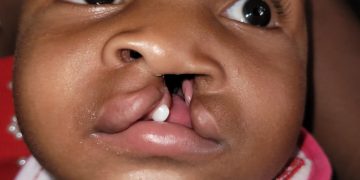 Inician amplia Jornada de labios leporino y paladar hendido