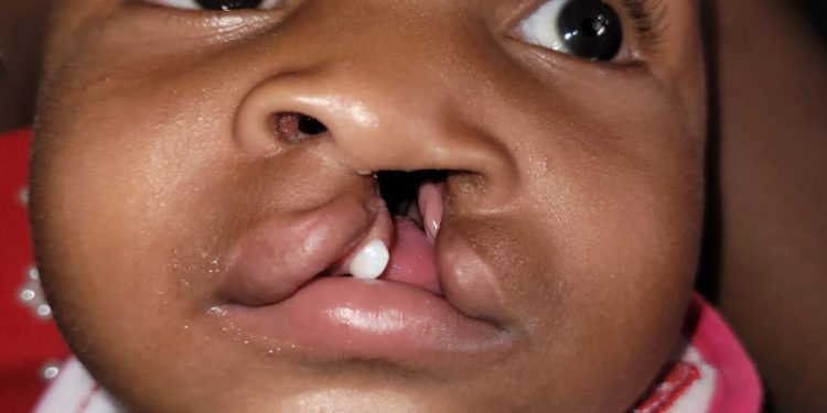 Inician amplia Jornada de labios leporino y paladar hendido