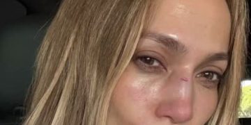 JLO sufre lesión en la cara tras accidente en un escenario
