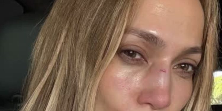 JLO sufre lesión en la cara tras accidente en un escenario