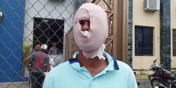 Por 200 pesos queman rostro a hombre con sancocho hirviendo en Santiago