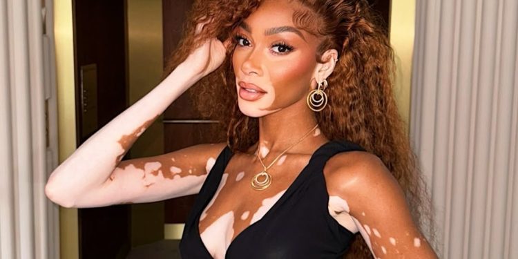 Día Mundial del Vitiligo: más allá de la piel, una causa global por la inclusión