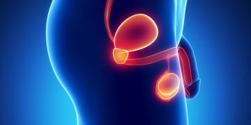 Rompiendo mitos: el cáncer de próstata no solo es una enfermedad de hombres mayores