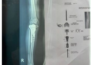 Aumentan tumores a nivel óseo en pacientes luego del COVID-19, afirman especialistas
