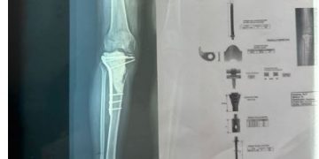 Aumentan tumores a nivel óseo en pacientes luego del COVID-19, afirman especialistas