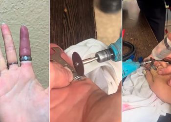 Equipo de bomberos salvó dedo de joven que había quedado atrapado por un anillo