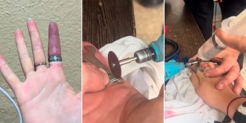 Equipo de bomberos salvó dedo de joven que había quedado atrapado por un anillo