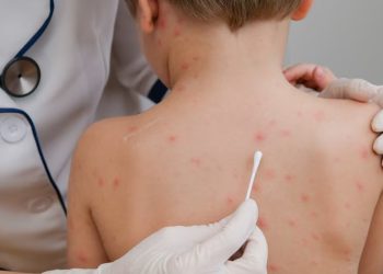 Autoridades sanitarias de Arizona y Utah monitorean el avance del mayor brote de sarampión en más de 30 años